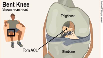 Front view drawing of male child's bent right knee shows thighbone above and shinbone below torn ACL.