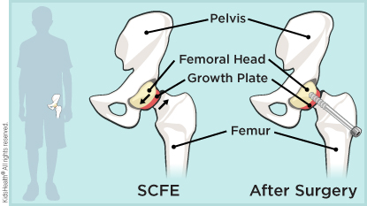 Pelvis, femoral head, growth plate, femur on normal hip and repaired SCFE. Repaired SCFE has screw through femur into femoral head.