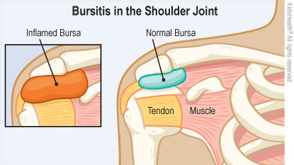 Illustration: bursitis in the shoulder