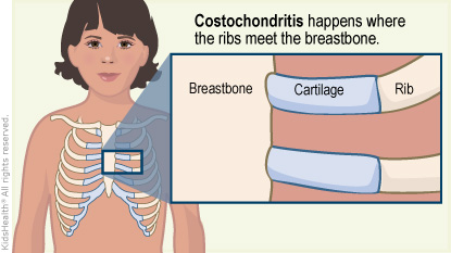 Illustration: costochondritis