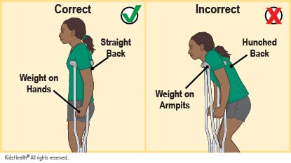 Correct way to use crutches is to keep a straight back and put weight on the hands. Incorrect way is to keep a hunched back and put weight on the armpits.