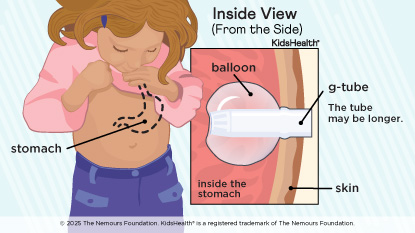view inside stomach of child with g-tube