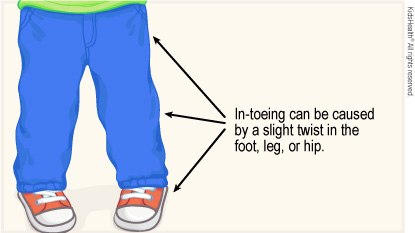 Diagram shows toddler with feet pointing inwards and arrows indicating places where in-toeing can be caused by a slight twist in the foot, leg, or hip. 