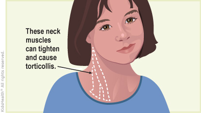 These neck muscles can tighten and cause torticollis.