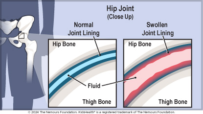 A close up of a normal hip joint shows fluid between the hip bone and thigh bone,  whereas a swollen joint lining has more fluid and inflammation. 