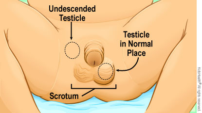 Diagram showing an undescended testicle and the other testicle in the normal position in the scrotum.
