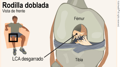 Vista frontal de la rodilla derecha doblada de un niño que muestra el fémur arriba del desgarro y la tibia por debajo.