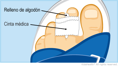 Illustration: buddy tape on toes