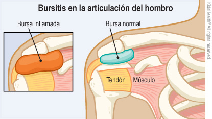 Illustration: bursitis in the shoulder