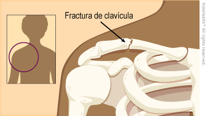 Illustration: Broken Collarbone