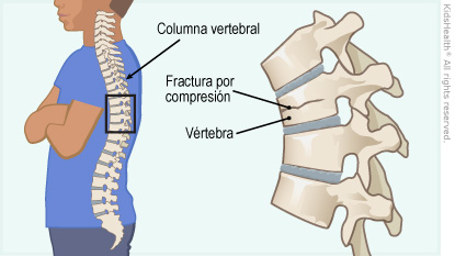 Ilustración de la columna vertebral que muestra una fractura por compresión tal como se describe en el artículo.