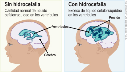 La primera ilustraci?n muestra el cerebro sin hidrocefalia y los ventr?culos con una cantidad normal de l?quido cefalorraqu?deo en los ventr?culos. La segunda ilustraci?n muestra el cerebro con hidrocefalia, los ventr?culos y un aumento de presi?n en los ventr?culos con un exceso de l?quido cefalorraqu?deo en los ventr?culos.