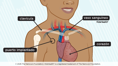   Se muestra a un niño con un puerto implantado, corazón, vaso sanguíneo y clavícula