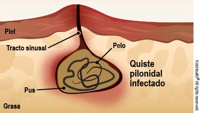 Corte transversal que muestra un quiste pilonidal lleno de pus infectado y pelo, debajo de la piel, con un tracto sinusal.